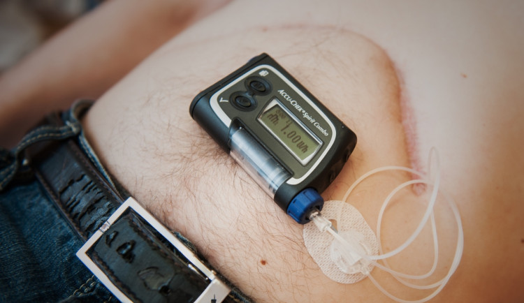 Léky na hubnutí snížily zájem o operace žaludku, jejich účinek je ale podle lékaře nižší